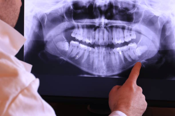 Best Emergency Wisdom Tooth Extraction in Jasmine Estates, FL
