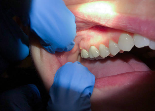 Best Broken or Chipped Tooth Repair in Jasmine Estates, FL